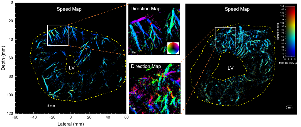 Transthoracic ultrasound localization microscopy of myocardial vasculature in&nbsp;patients